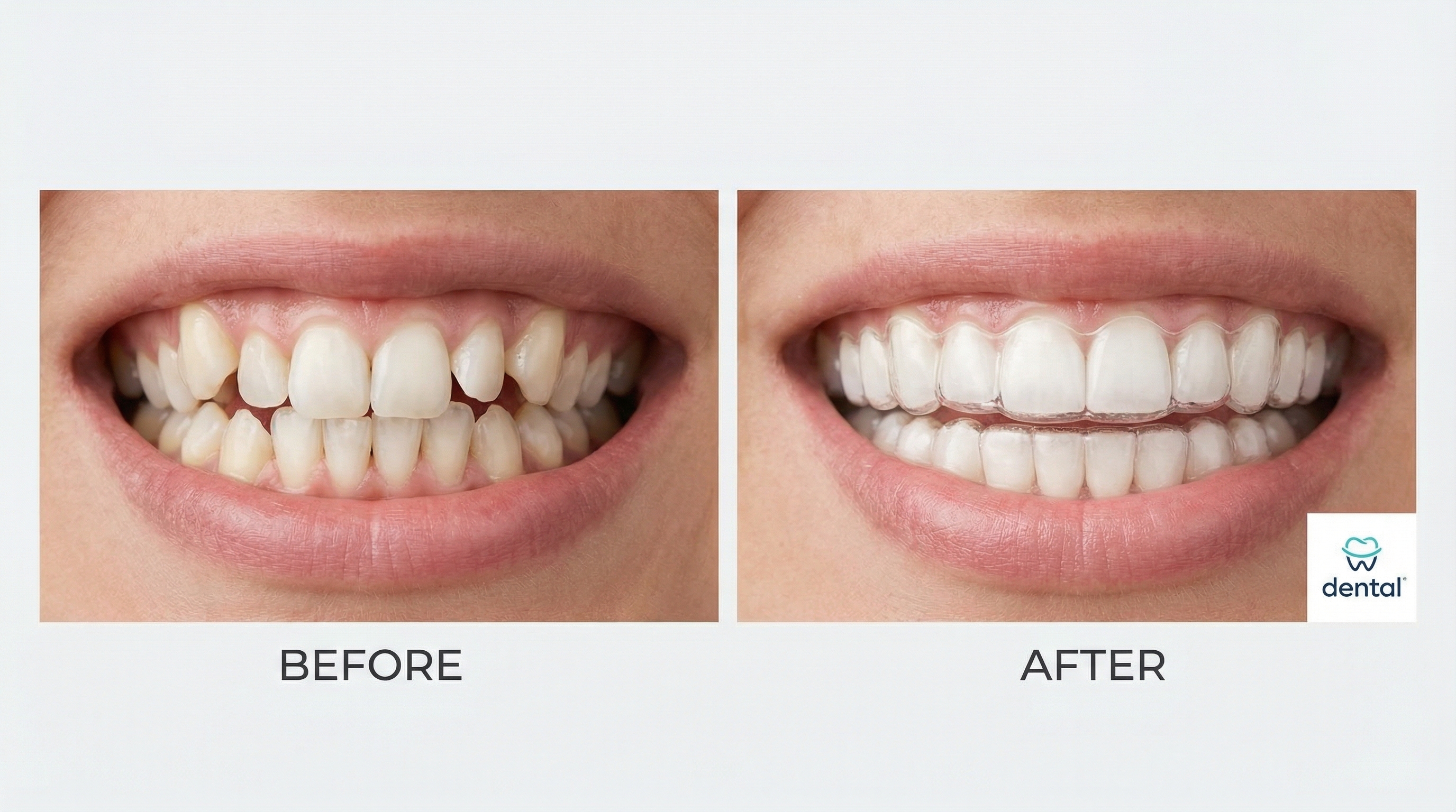 Clear Aligners